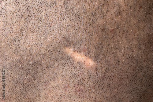 Scar on the scalp of a man with shaved hair photo