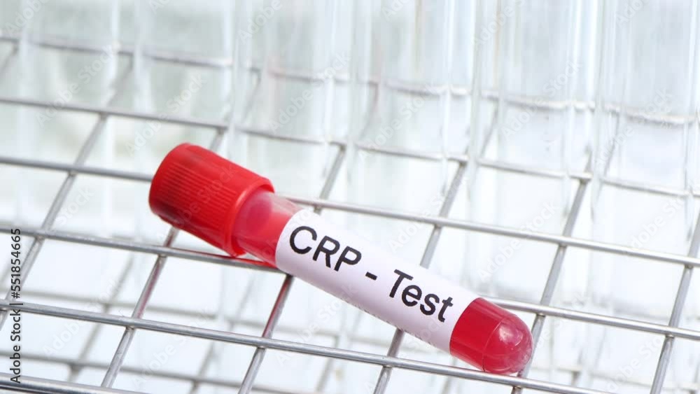 CRP test to look for abnormalities from blood, blood sample to analyze