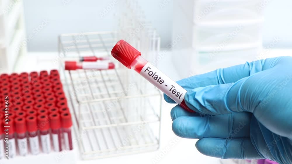 Folate test to look for abnormalities from blood, blood sample to analyze in the laboratory Folate test to look for abnormalities from blood, blood sample to analyze in the laboratory
