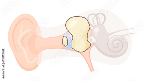 真珠腫性中耳炎のイラスト_鼓膜癒着型真珠腫