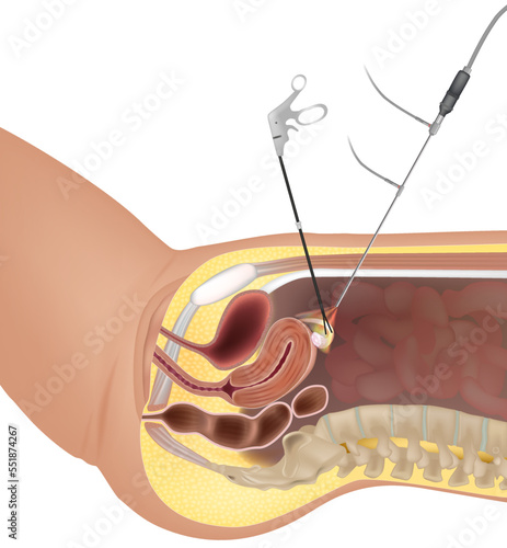 Gynaecological Laparoscopy procedure. Laparoscopic instruments. Hysteroscopy Surgery. Fertilization by extracting eggs.