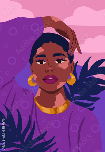 Portrait of a beautiful woman with vitiligo. Self love concept