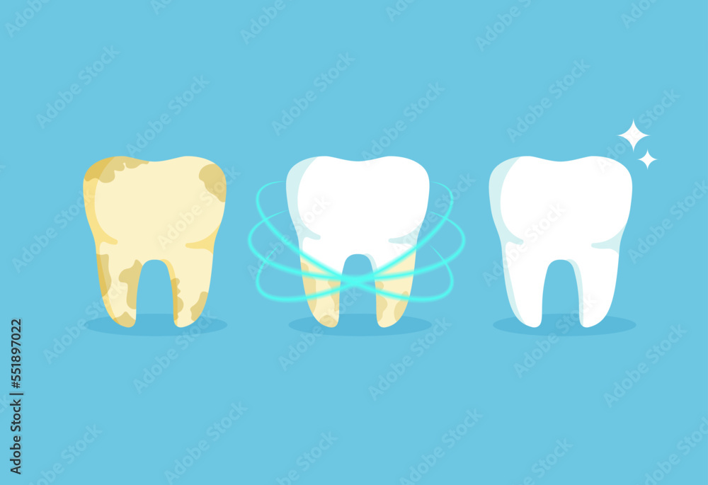 Cleaning teeth. Snow-white and yellow tooth. Before and after whitening. Dental health concept. Vector illustration isolated on blue background Cleaning teeth. Snow-white and yellow tooth. Before and after whitening. Dental health concept. Vector illustration isolated on blue background