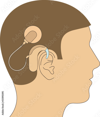 deaf person with a cochlear implant