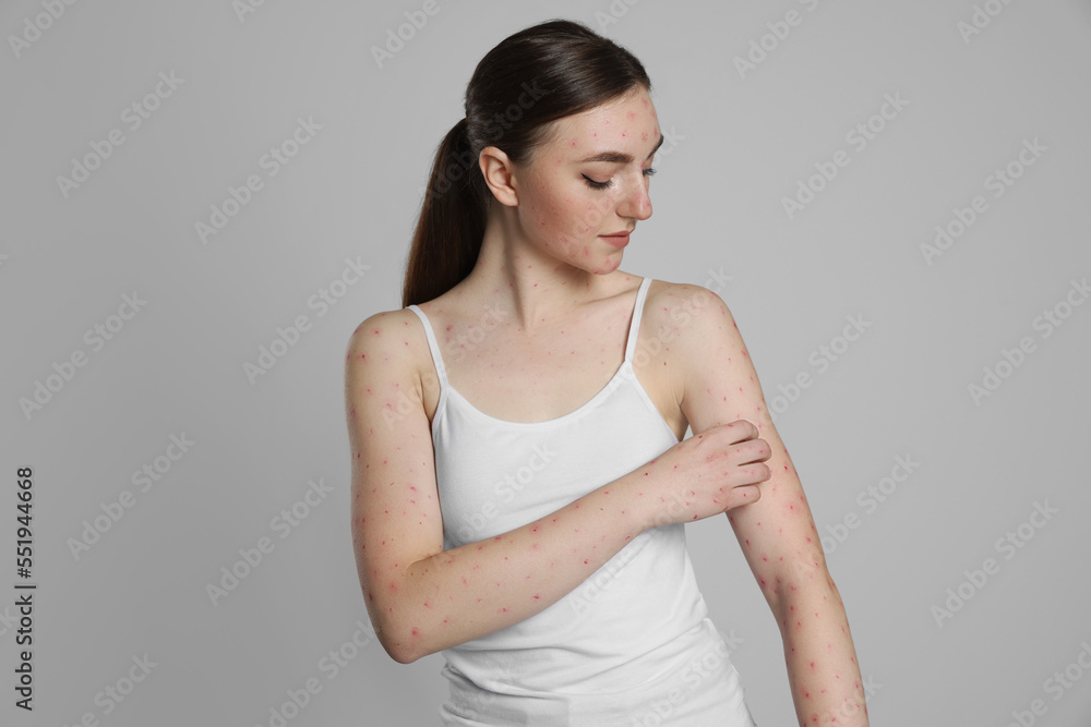 Woman with rash suffering from monkeypox virus on light grey background Woman with rash suffering from monkeypox virus on light grey background