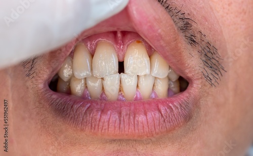 Принти на полотні Huge gap between the front teeth or incisors of Asian Chinese man