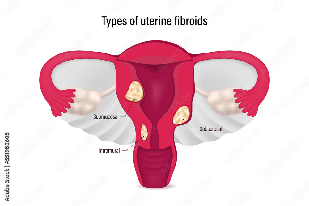 Types of uterine fibroids. Submucosal, Subserosal and Intramural ...