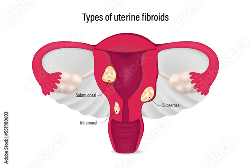 Types of uterine fibroids. Submucosal, Subserosal and Intramural fibroids. Female reproductive system.