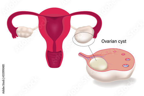 Ovarian cyst. Female reproductive system. Human uterus.