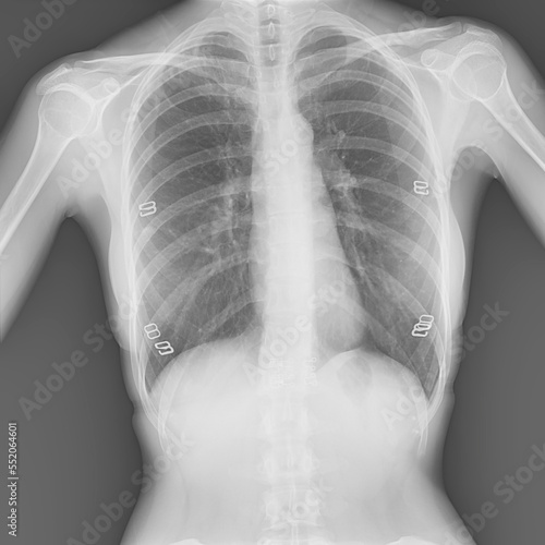 Chest x-ray with bra hook of a woman 42 year old finding some clue that may cause of TB.