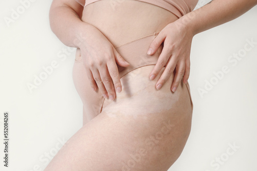 Cropped view of a young beautiful plump woman with vitiligo posing in her underwear. Traces of vitiligo on the abdomen, body positive.