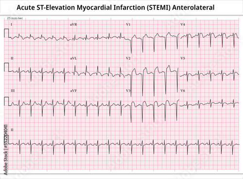 Acute ST-Elevation Myocardial Infarction (STEMI) Anterolateral - ECG Paper 12 Lead