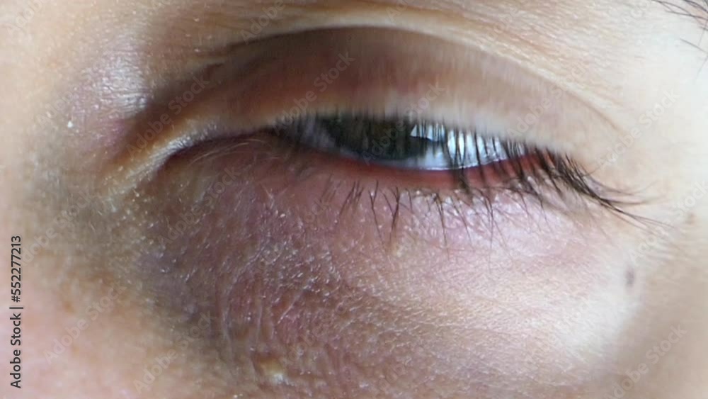 Caucasian skin boy's left eye blink with visual nystagmus - 1 Caucasian skin boy's left eye blink with visual nystagmus - 1