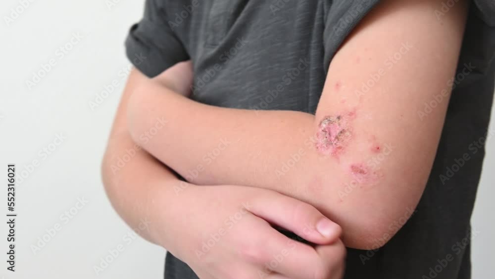teenager scratching his hand with allergic lesions on the skin.skin of the hands with red wounds of diathesis and dermatitis from allergies and stress close-up teenager scratching his hand with allergic lesions on the skin.skin of the hands with red wounds of diathesis and dermatitis from allergies and stress close-up