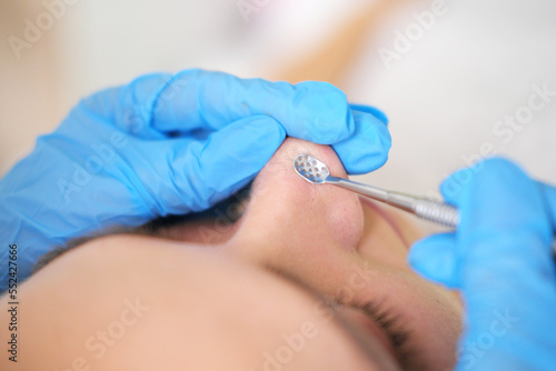 Close up  mechanical cleaning of the face around the nose patient spa salon using an extractor