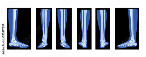 Set of X-Ray Foot Legs Skeleton Human body, Bones adult people roentgen front back side view. 3D realistic flat blue color concept Vector illustration of medical anatomy isolated on black background