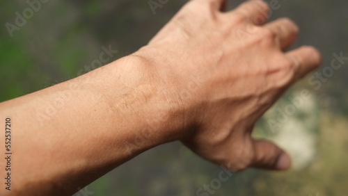 stitches on Male's wrist © Dennis