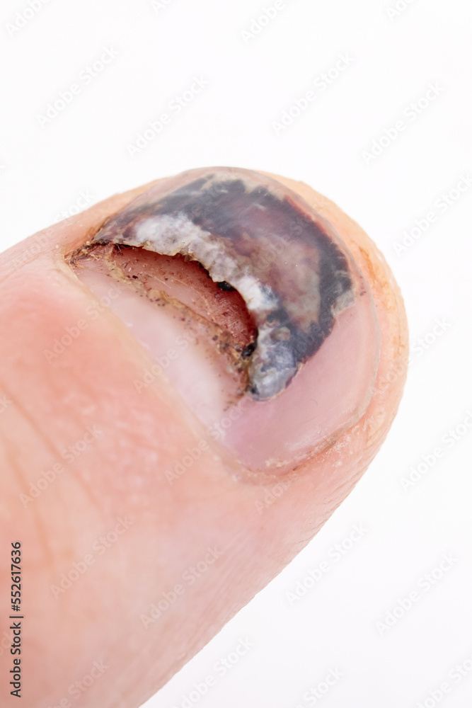 Obraz premium Nail peels off on finger and bruise