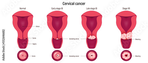 Cervical cancer development. cervix carcinoma stages. Female reproductive system disease.