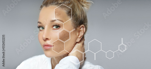 Dark spots, freckles,hyperpigmentation(melasma or chloasma),concept - skin lightening, skin whitening, fruit acids,AHA, Skin Brightening