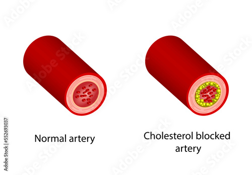Normal artery versus Narrowed artery blocked with cholesterol plaque. Blood vessel blocked with a clot. High cholesterol level as atherosclerotic risk. Medical concept. Vector illustration.
