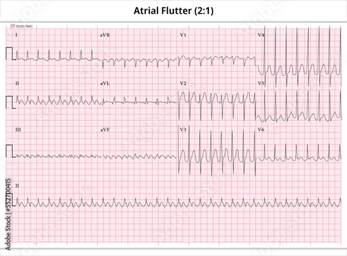 ECG Atrial Flutter (2:1) - ECG Paper 12 Lead
