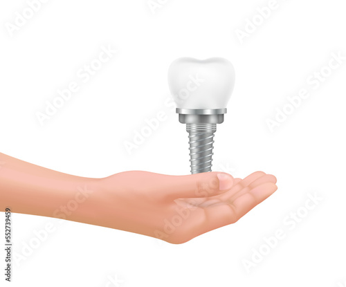 Dentist holds dental implant in hand. Healthy white tooth isolated on white background. Medical dental treatment and whitening concept. Realistic 3D Vector illustration.