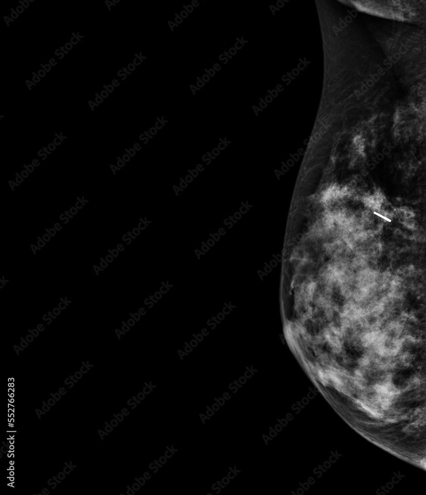 Xray Digital Mammogram or mammography of both side breast showing