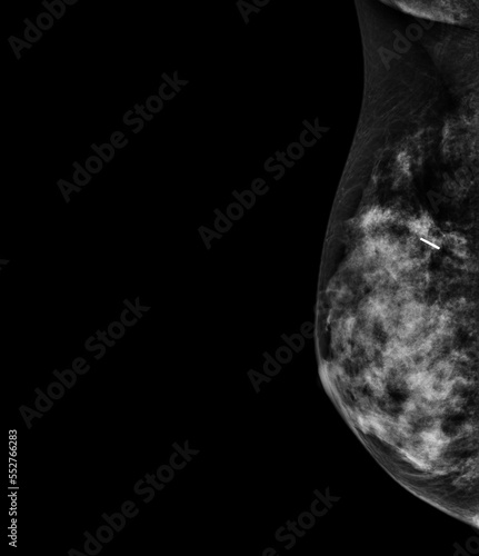 X-ray Digital Mammogram or mammography of both side breast showing benign tumor BI-RADS 2 should be checked once a year. photo