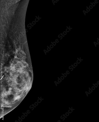 X-ray Digital Mammogram or mammography of both side breast showing benign tumor BI-RADS 2 should be checked once a year. photo