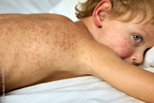 Courageous child lying steadfastly endures an unpleasant disease in the form of a red rash throughout the body. Big-eyed baby lies in bed more chicken pox photo