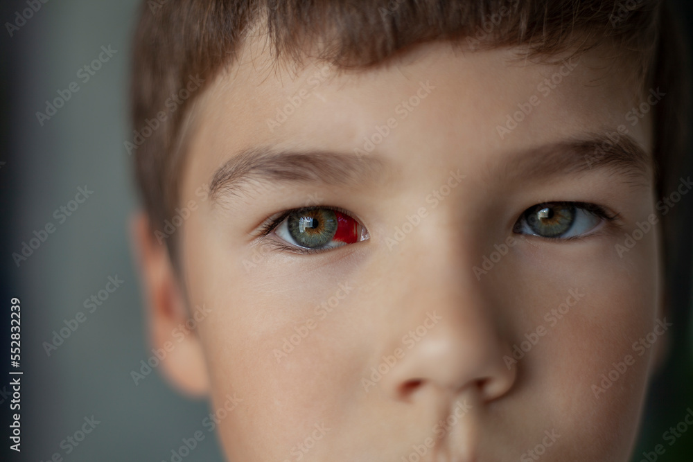 close-up of the boy's face with a red spot on the eyeball close-up of the boy's face with a red spot on the eyeball