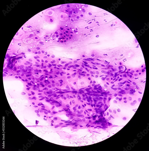 Pap's smear. Microscopic showing inflammatory smear with early atrophic changes. NILM. cervical cancer diagnosis. Abnormal squamous epithelial cells. photo