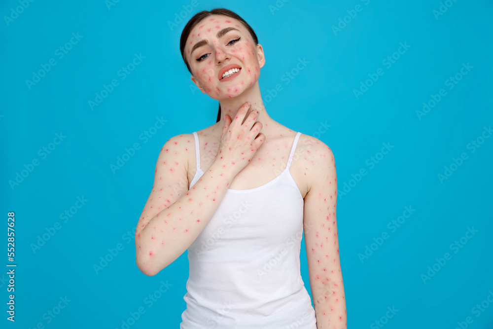 Woman with rash suffering from monkeypox virus on light blue background Woman with rash suffering from monkeypox virus on light blue background