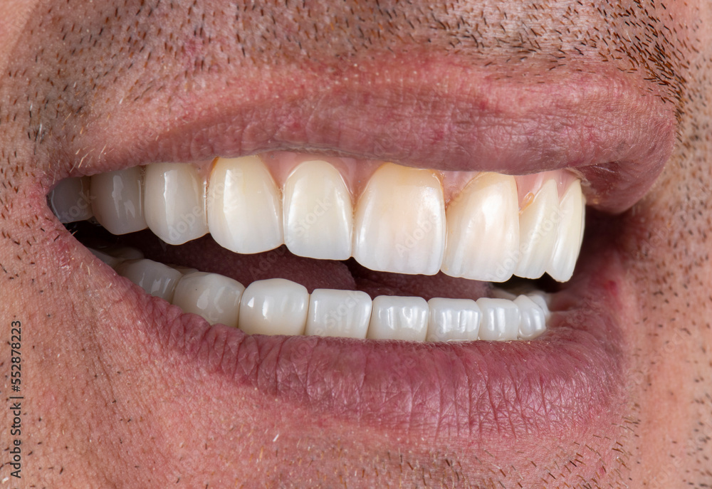 Obraz premium emax crowns on hybrid bridge on implants