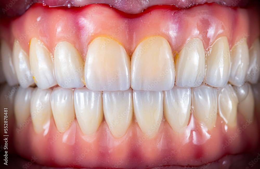 emax crowns on hybrid bridge on implants emax crowns on hybrid bridge on implants