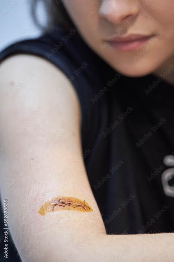 the girl looks at the wound after surgery, surgical suture, wound on the arm, iodine treatment of the suture