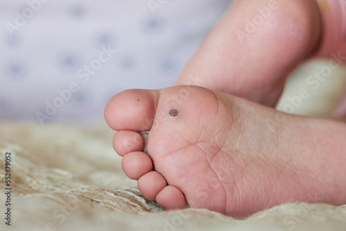 Close-up of a wart on a child's foot, a new wart is visible on the big toe..