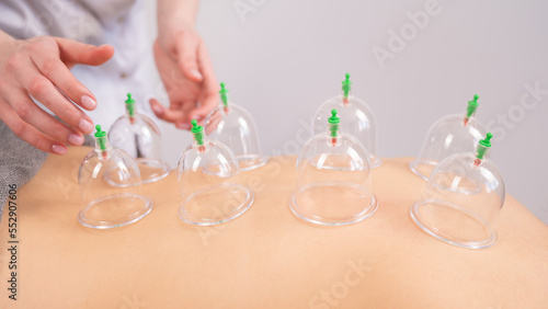 Female massage therapist uses vacuum cans on the patient s back. 