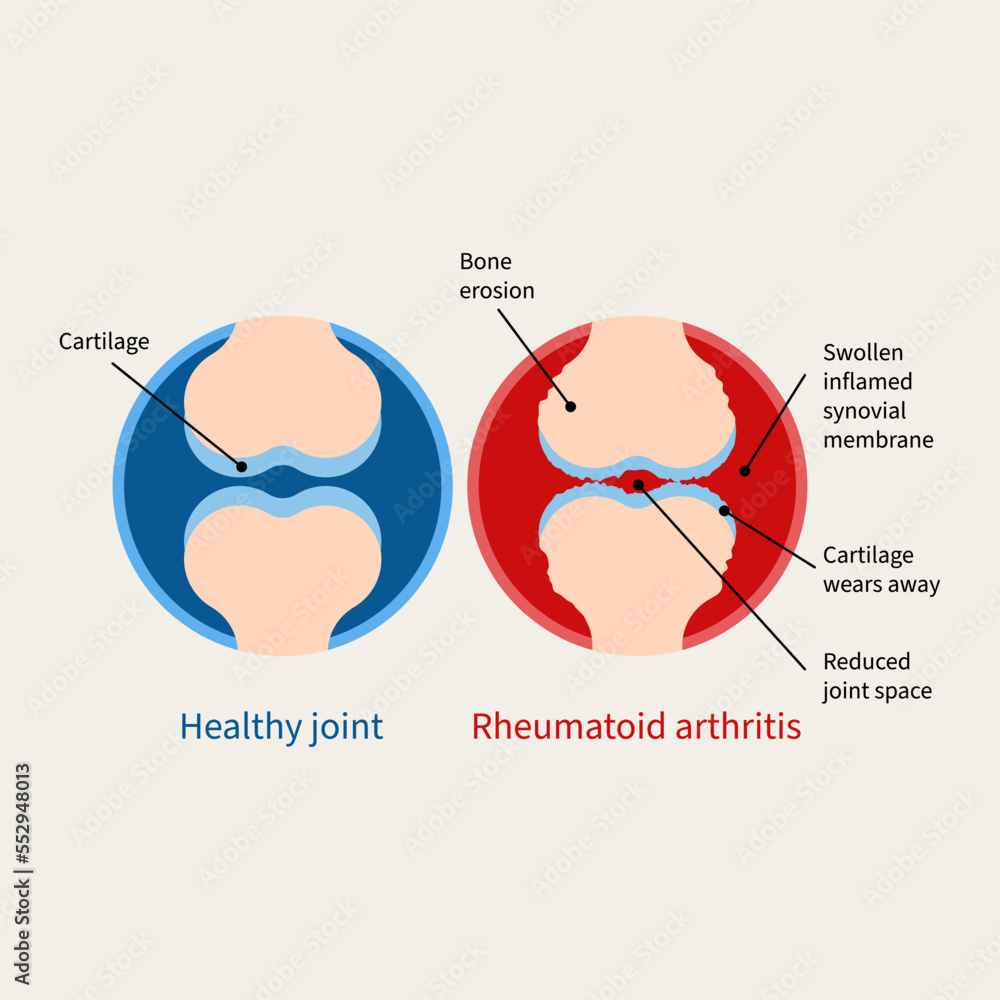 Obraz premium Rheumatoid arthritis illustration