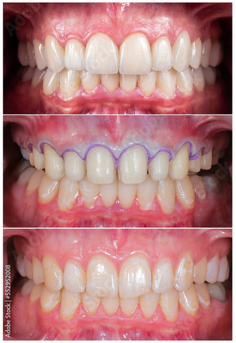 dental before and after picture of placing ceramic veneers