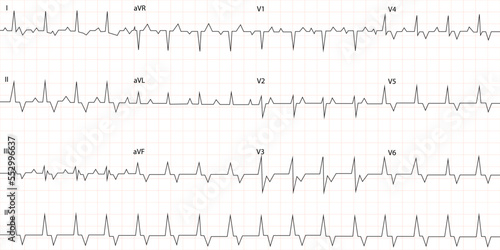 Vector illustration of a cardiogram. Transparent background with a heartbeat line. Medication, pulse, electrocardiogram, heart rate.