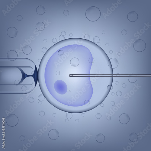 The process of artificial insemination. The sperm is artificially injected into the egg. Medical poster. Vector illustration.