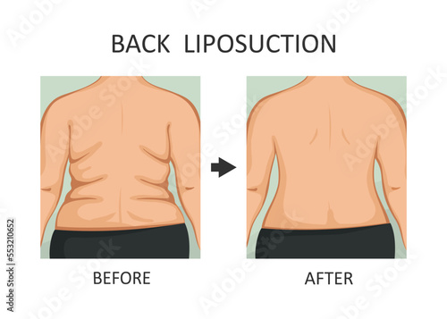 Back Lift. Back before and after diet, fitness or liposuction