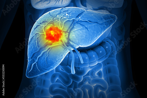Liver cancer, Hepatocellular Carcinoma (HCC), conditions, causes and treatment. 3d illustration photo