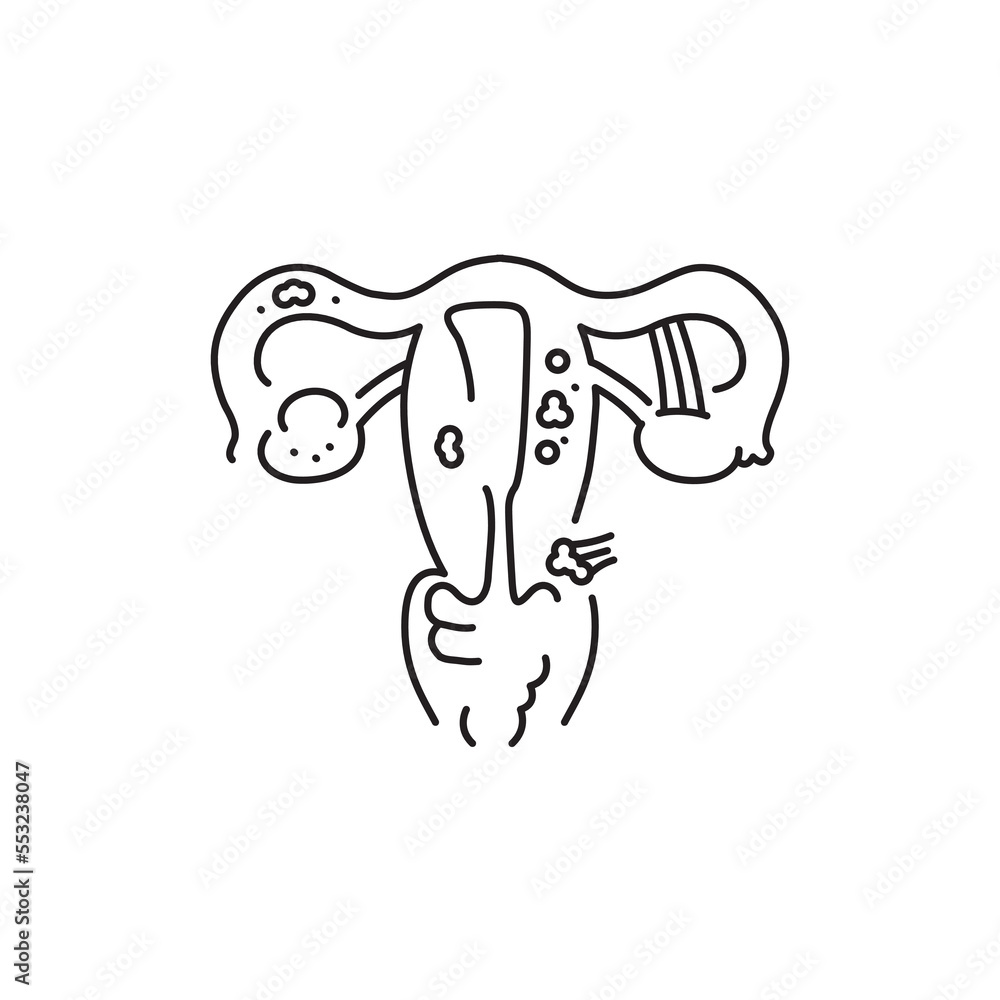 Endometriosis color line icon. Gynecology problem Endometriosis color line icon. Gynecology problem