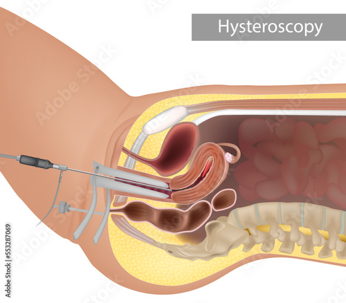 Anatomic illustration of a modern hysteroscopic procedure. Inspection of the uterine cavity by endoscopy. Hysteroscopy procedure
