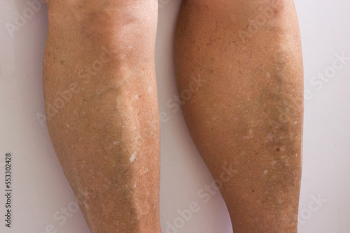 Fényképezés Freckled legs, white spots from age or sun exposure leucoderma