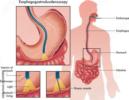 Medical illustration of an Esophagogastroduodenoscopy with two details showing the procedure and instruments used, with annotations. photo