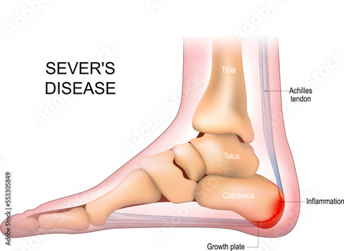 Severs disease. calcaneus apophysitis. inflammation at the back of the heel growth plate.